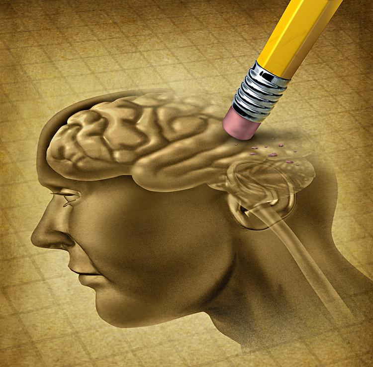Alzheimer atrofia o cérebro de uma forma geral. Entenda! 