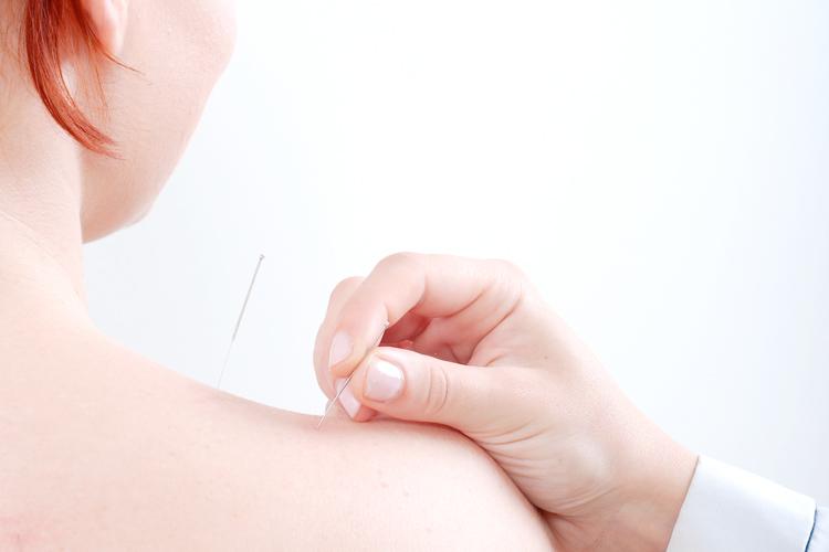 Pré-verão: acupuntura pode reduzir inchaço e ajudar a eliminar gordura 