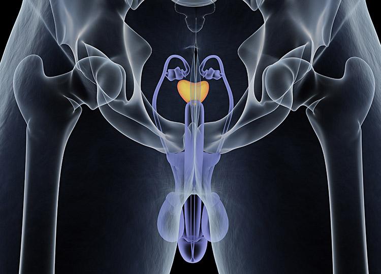 Câncer de próstata: confira 5 sintomas da doença! 