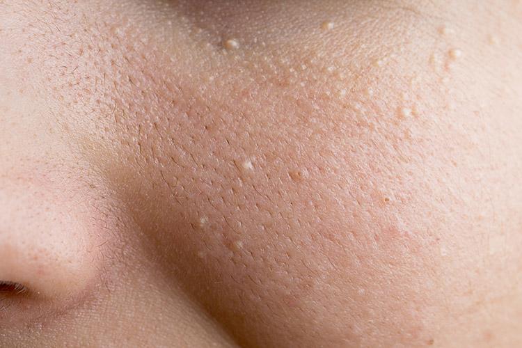Milium: entenda mais sobre esse problema de pele que é muito comum! 