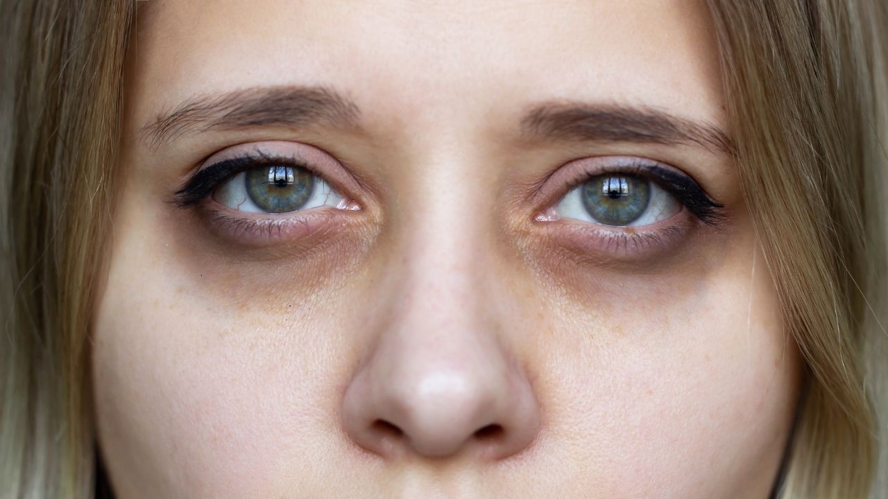 5 dicas para reduzir as olheiras de forma natural