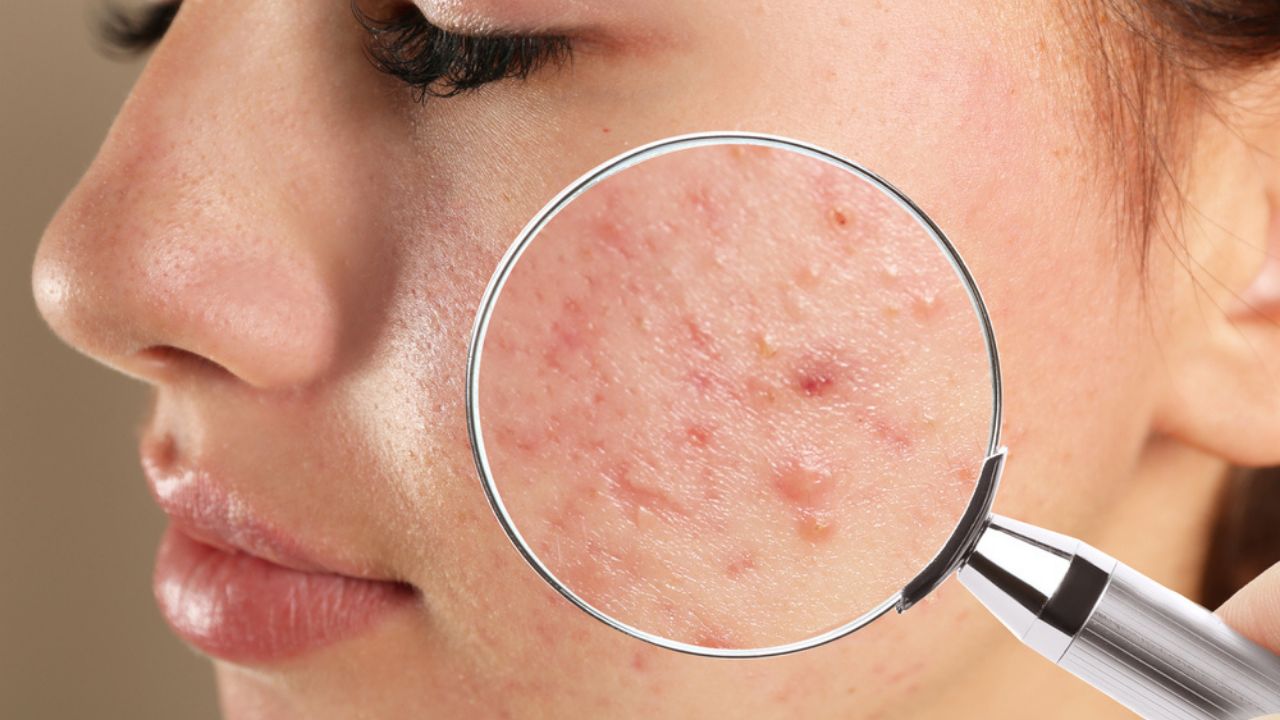 Veja como diminuir os efeitos causados pela acne e os cuidados para evitar sua volta