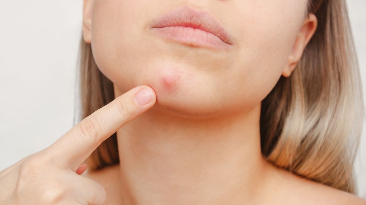 Apesar de ser comum na adolescência, a acne também pode atingir bebês, crianças e adultos; veja causas e tratamentos