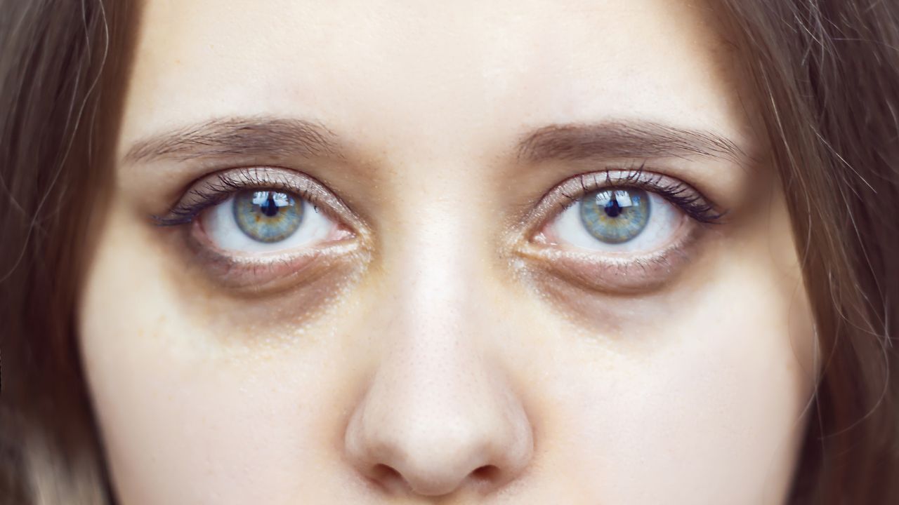 As 5 principais causas das olheiras e como tratá-las