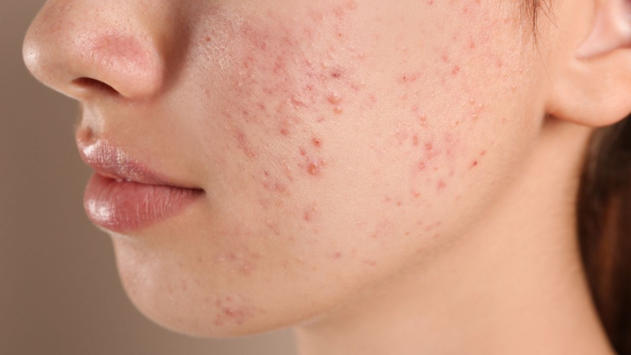 Tudo o que você precisa saber sobre as cicatrizes de acne
