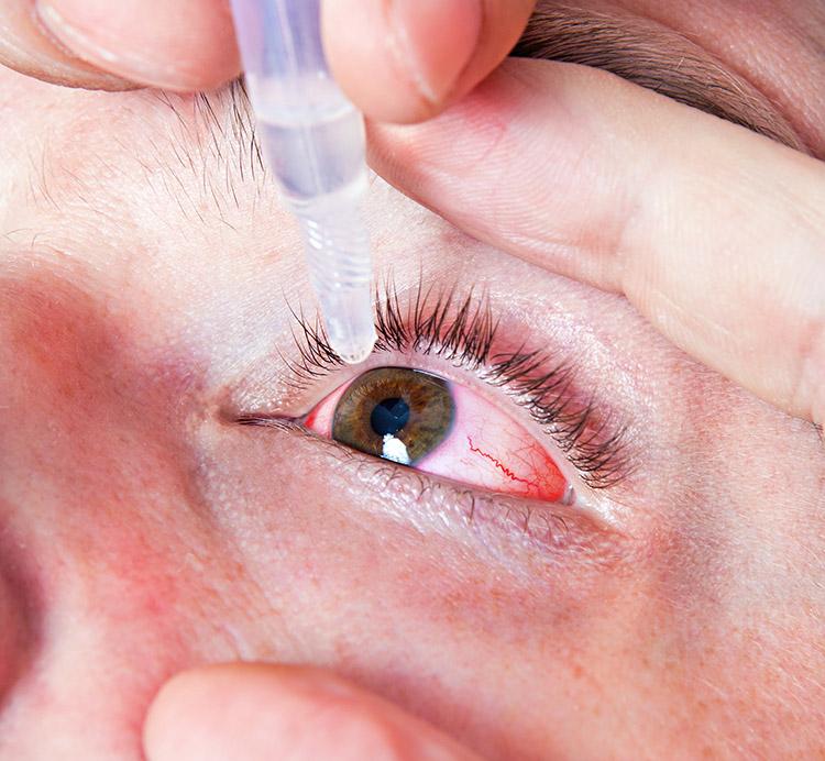 O glaucoma é uma doença crônica e progressiva, que pode causar danos irreversíveis à visão. Portanto, fique atento às suas causas e aos seus danos.