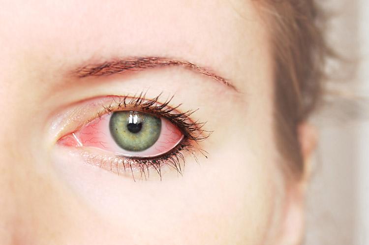 Saúde dos olhos: cuidados necessários com a conjuntivite 