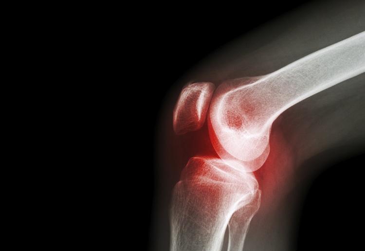 Conheça três dicas que podem contribuir para prevenção dos seus efeitos da artrite e artrose, mantendo a qualidade das articulações por toda a vida!