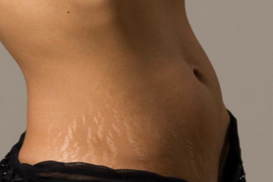 Estrias: causas, prevenção e alimentação correta para evitar as marcas na pele 