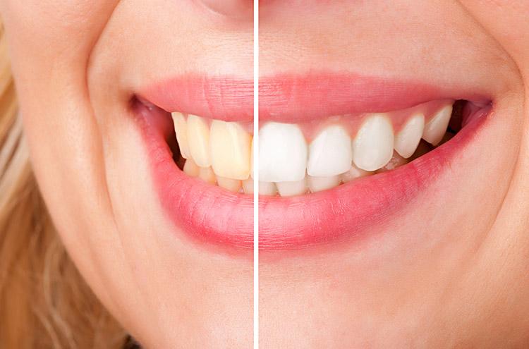 Clareamento dental: confira quais são os mitos e verdades! 