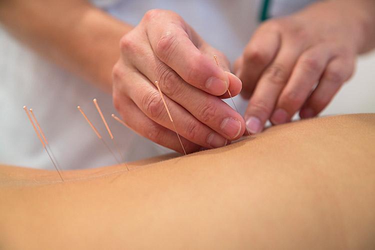 Você sabia que é possível fazer acupuntura pelos SUS? Veja como! 