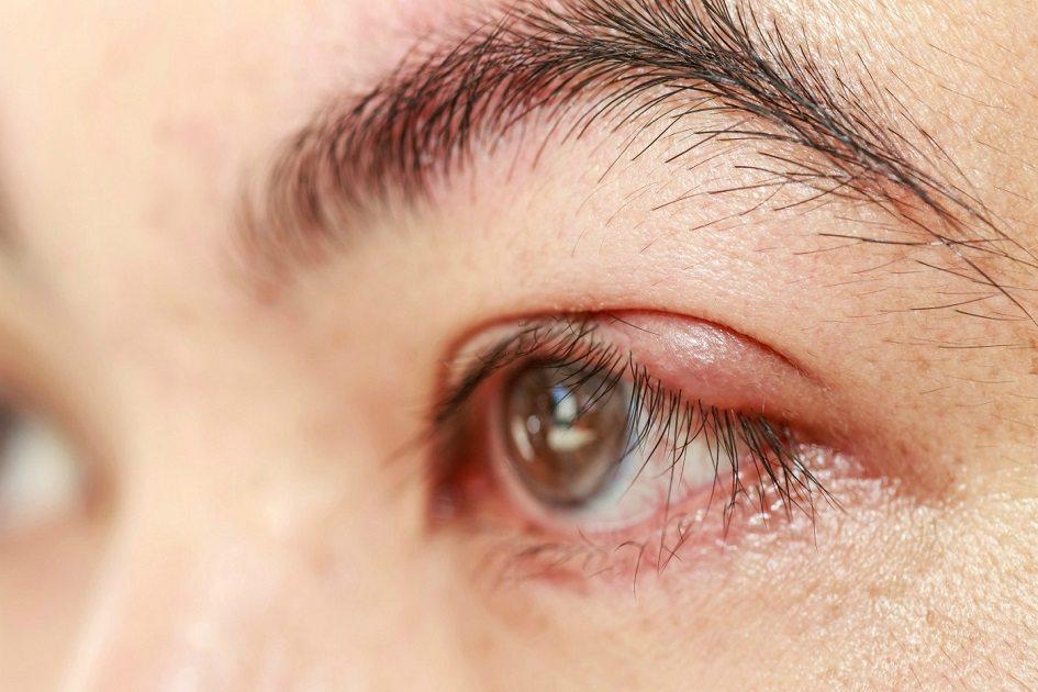 Os olhos são partes sensíveis do corpo, por isso são necessários cuidados! Pensando nisso, conheça as principais diferenças entre terçol e calázio!