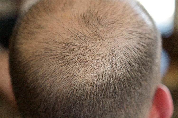 Perda de cabelo prematura: quem são os mais afetados? 