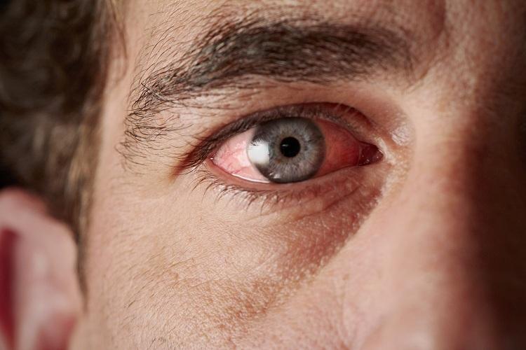 As causas da síndrome do olho seco são diversas: tempo seco, computador, ar condicionado... os olhos precisam de umidade!
