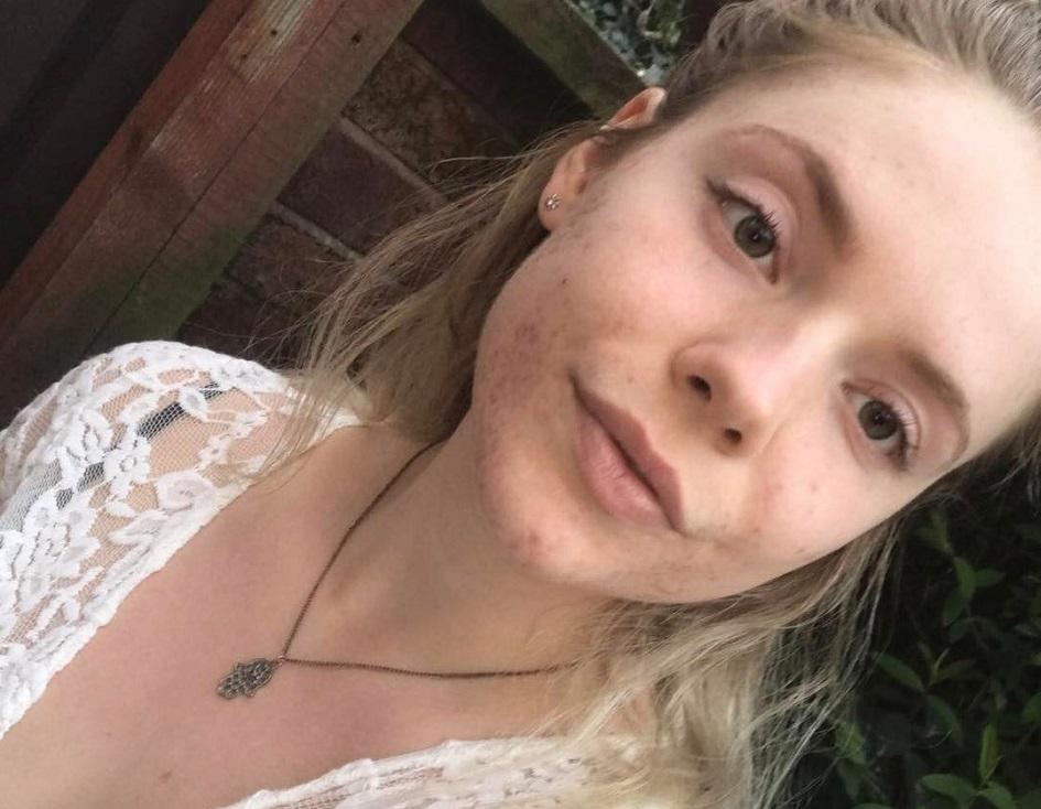 A britânica Rachel Crawley sofria de acne severa antes de cortar de vez um ingrediente de sua dieta! Confira a história da jovem