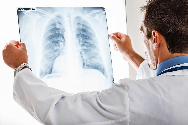 Hipertensão pulmonar: conheça a doença e seus sintomas 