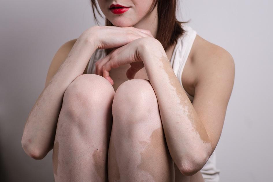 O vitiligo é uma doença autoimune, que provoca manchas brancas na pele. O diagnóstico é feito por um médico e o tratamento é por meio da fototerapia.