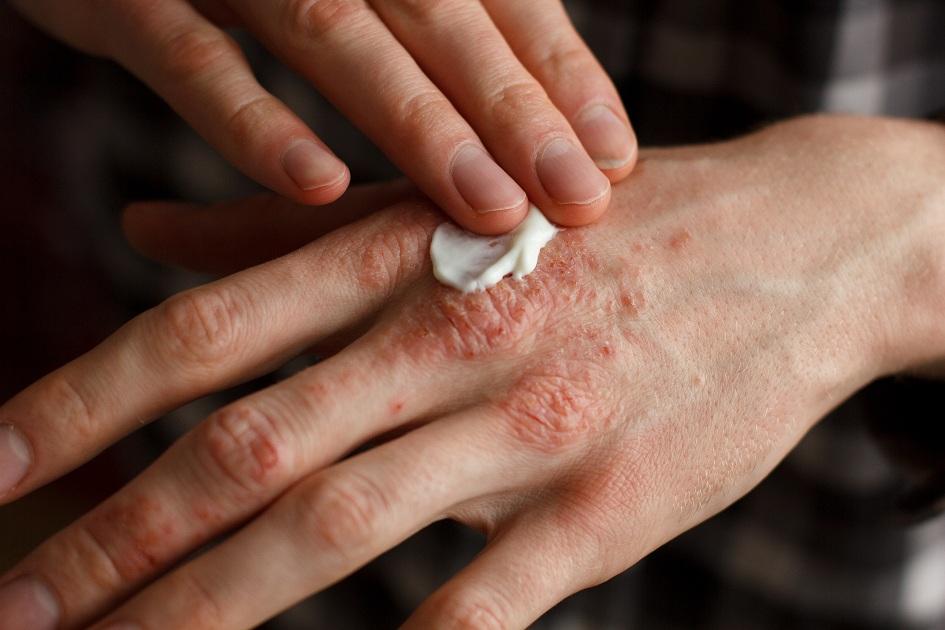Micose e outras doenças de pele: descubra como tratá-las e previna-se! 