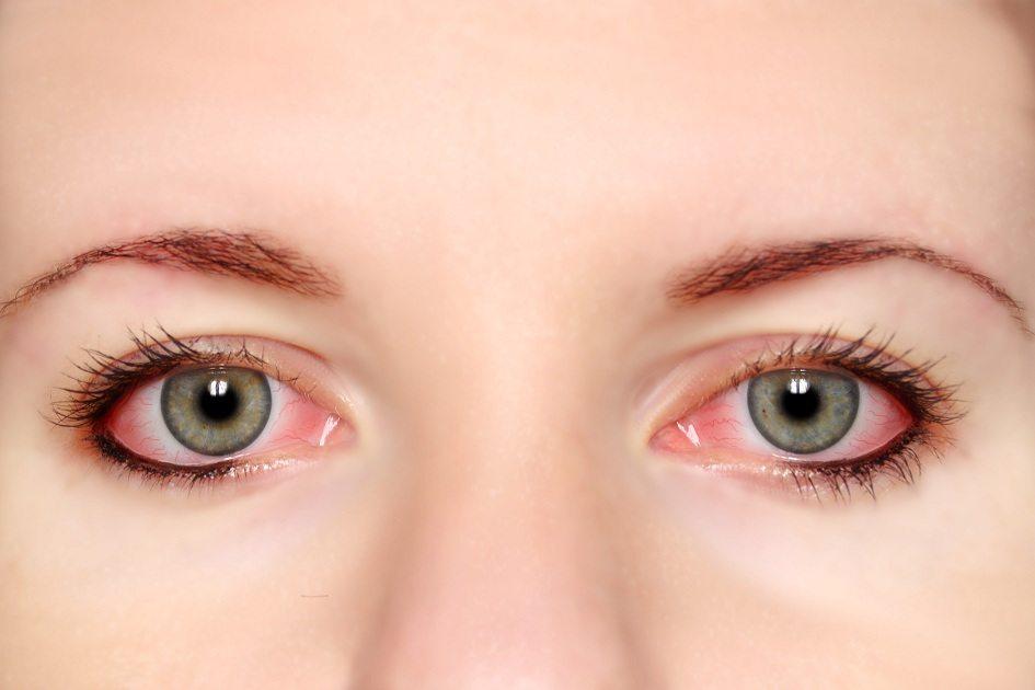 Lesão ocular provocada principalmente por ação bacteriana, o terçol é caracterizado por inchaço e vermelhidão na região das pálpebras