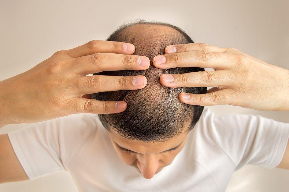 Confira 7 mitos e verdades comuns sobre as causas de queda de cabelo! 