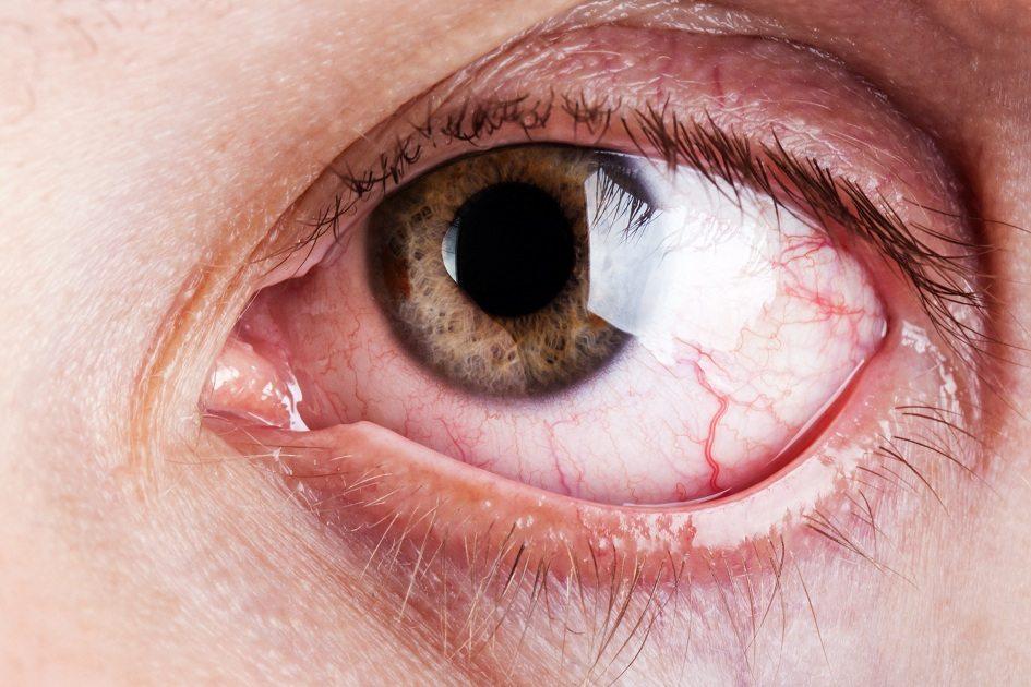 Patologia que atinge uma parcela da população causa coceira e irritações oculares, podendo gerar graves complicações. Conheça as causas do olho seco