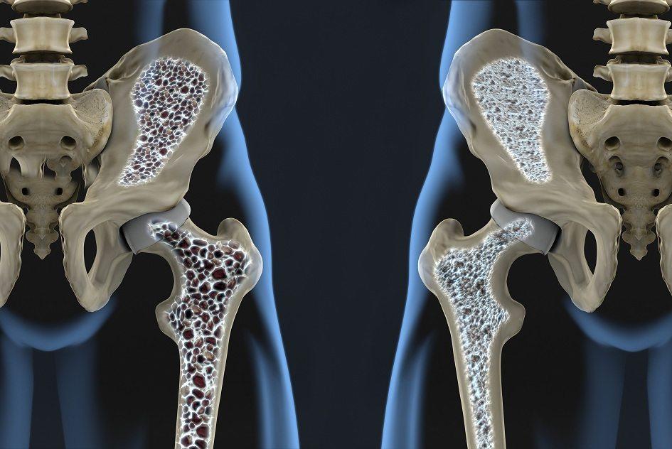 Cardápio rico em cálcio é fundamental para prevenção da osteoporose 