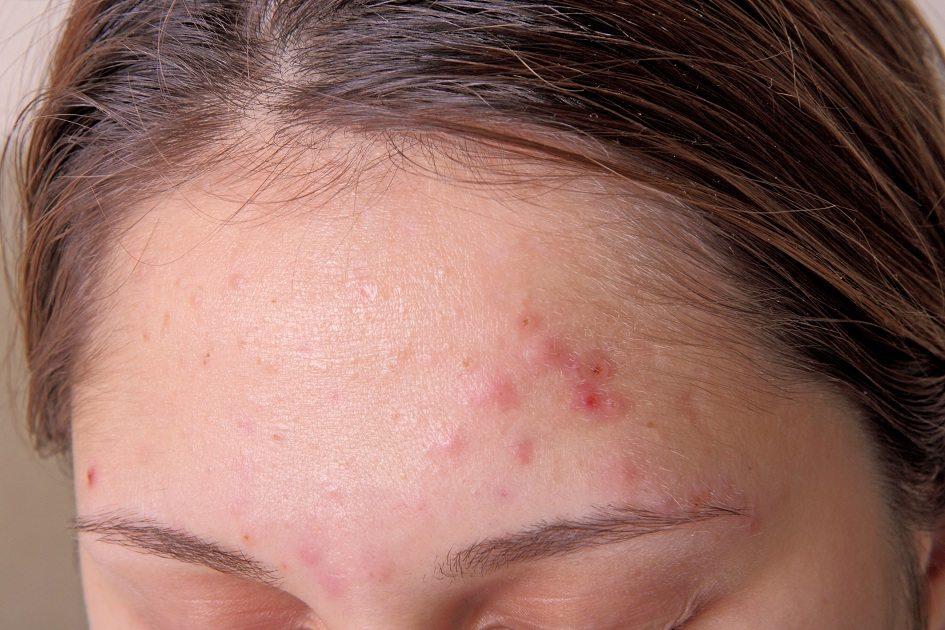 Livre-se das acnes por meio de um tratamento ortomolecular feito com argila! 
