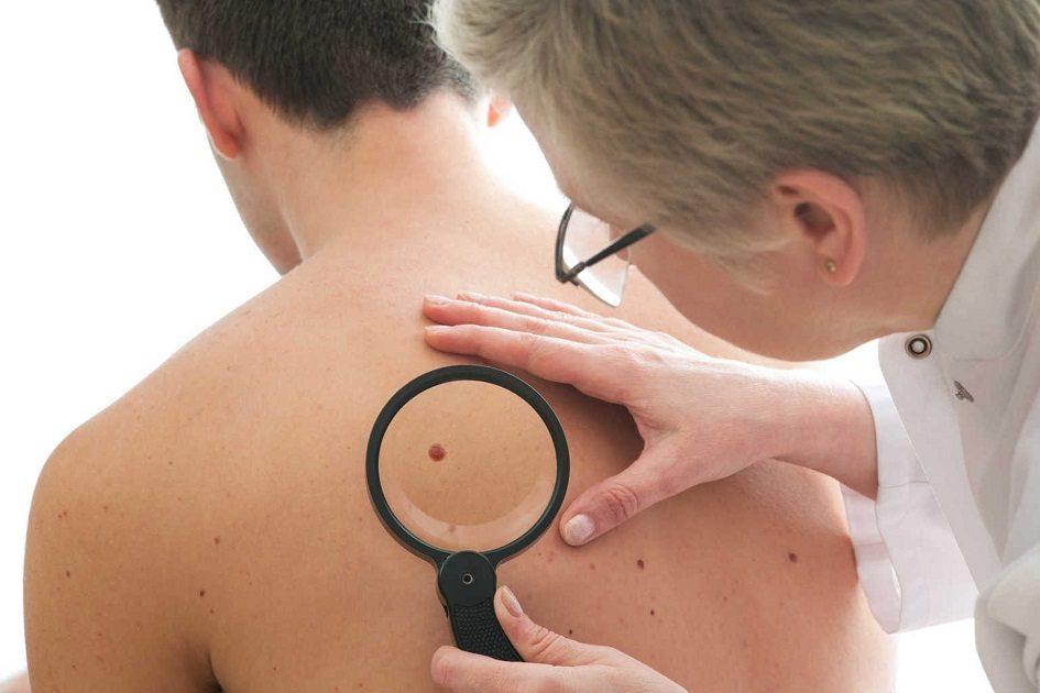 Sabia que manchas na pele podem indicar câncer? 