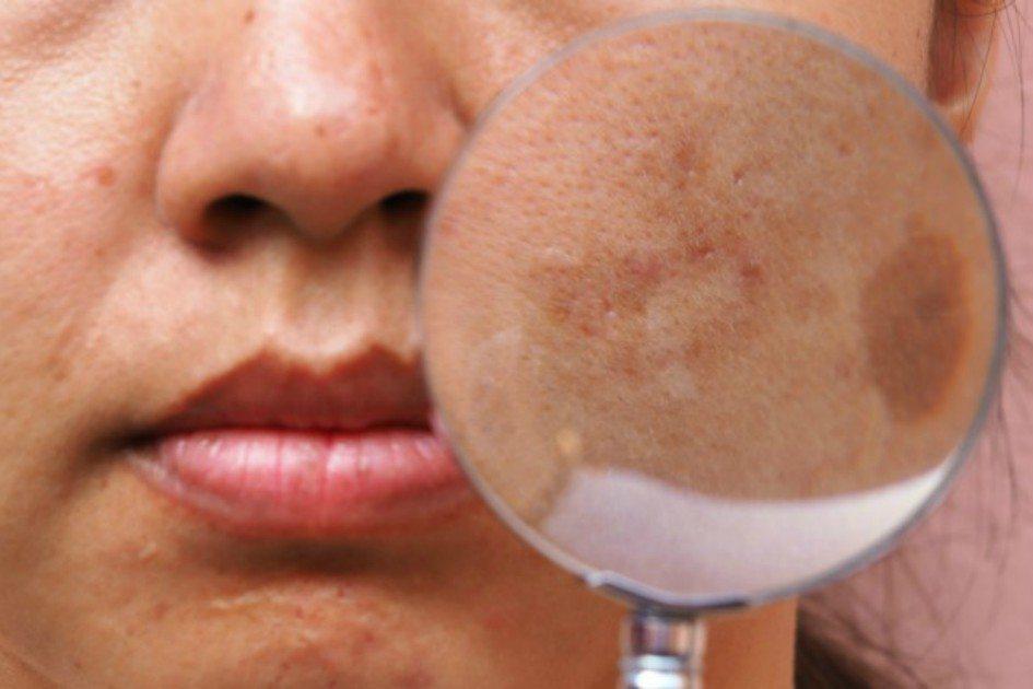 Manchas de limão na pele: como eliminar e quais cuidados tomar durante o verão 