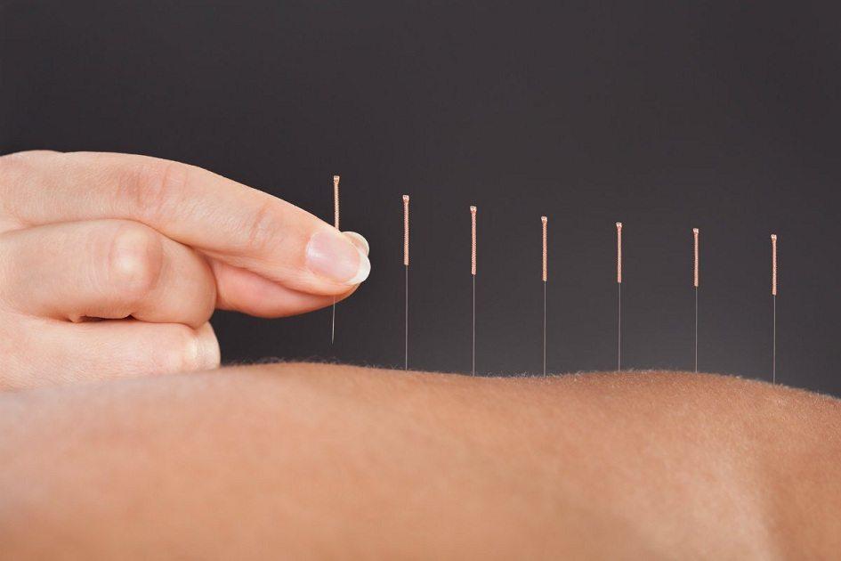 Ramo da medicina chinesa tradicional, a acupuntura também serve como alternativa para o realce da beleza – sobretudo em tratamentos de pele