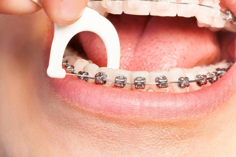 É muito comum ter dúvidas sobre procedimentos médicos. Por isso, selecionamos 6 mitos e verdades sobre o uso de aparelho dental. Confira!