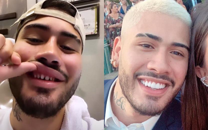 O cantor Kevinho viralizou na internet esta semana ao aparecer sem a lente de contato dental. Saiba o que é e como funciona o procedimento!