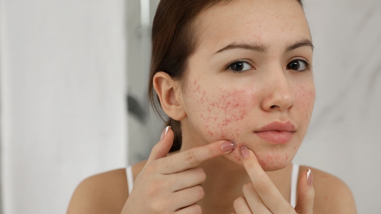 Farmacêutico explica que a camomila pode ser usada em receitas naturais para combater os efeitos da acne