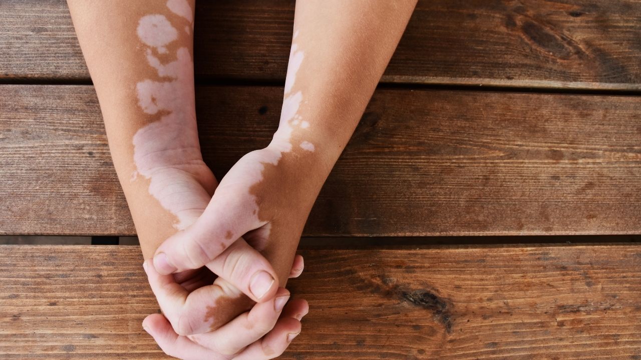 Vitiligo: conheça a doença que causa manchas brancas na pele