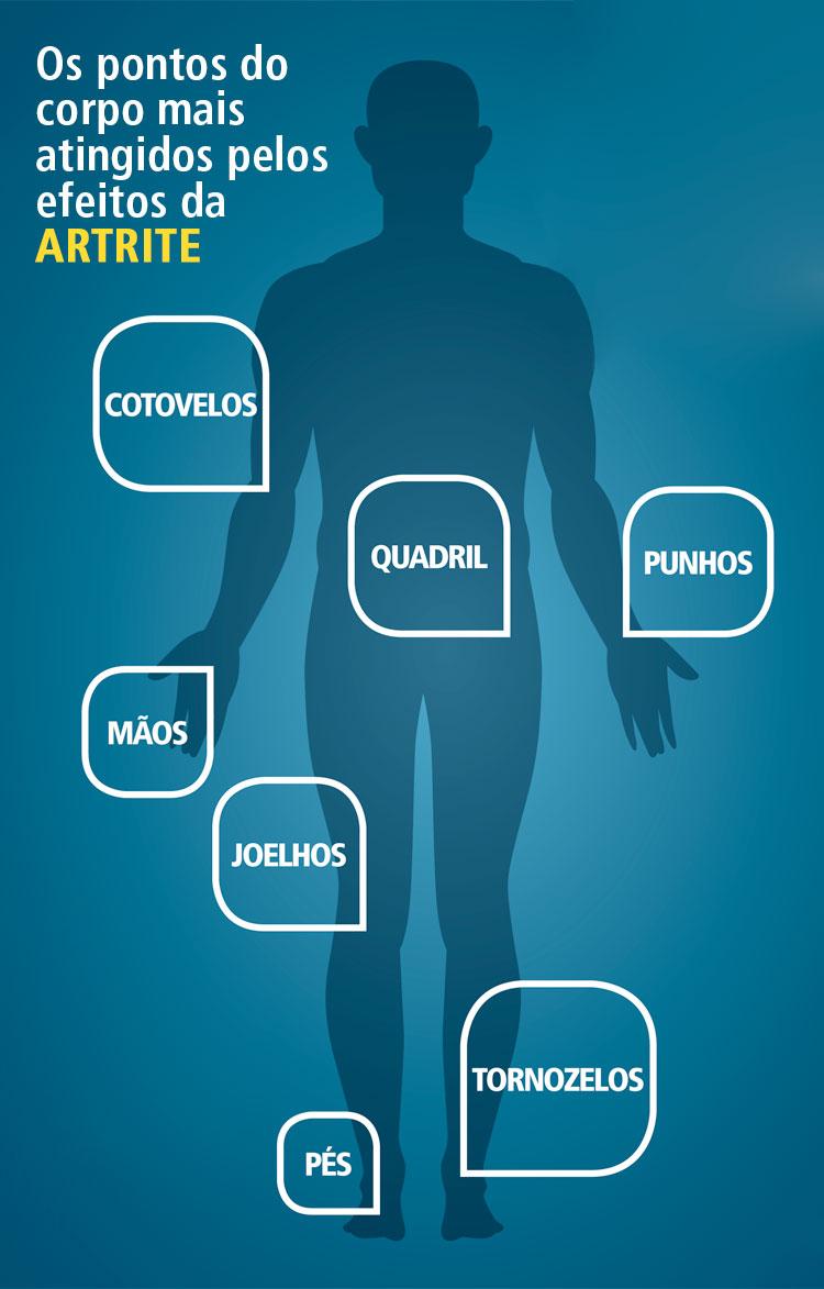 artrite-dores-nas-articulacoes-mapa-da-dor-onde-doi
