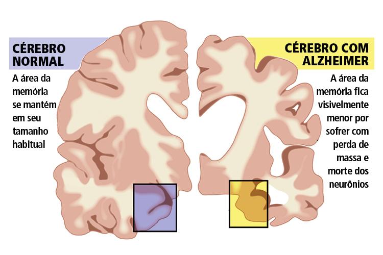 cérebro-alzheimer-efeitos