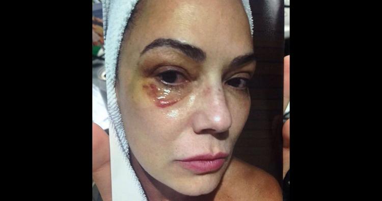 Luiza Brunet aparece com hematoma após agressão