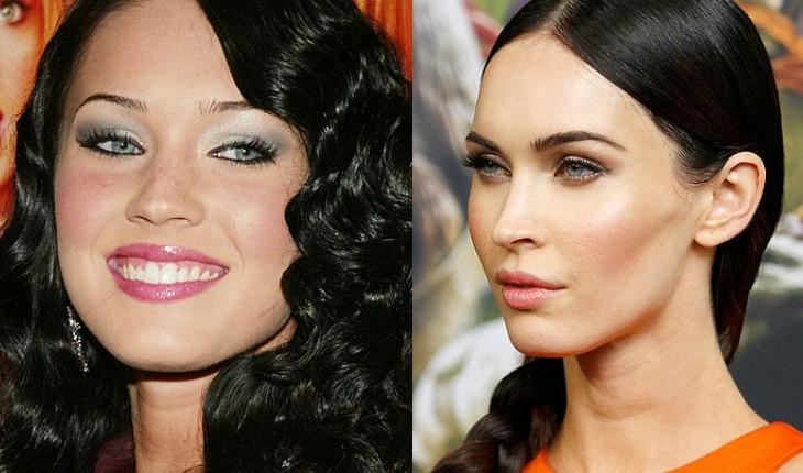 Antes e depois de Megan Fox após bichectomia