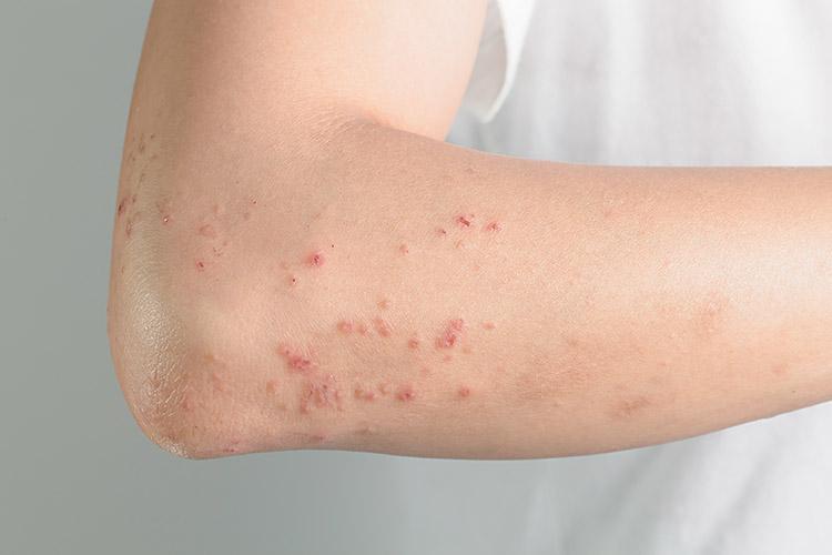 A alergia pode atingir a pele a causar coceira