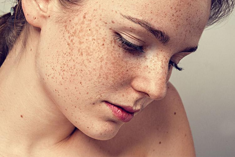 O inchaço pode atingir o rosto e ser consequência de problemas de saúde