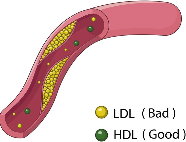 ilustração mostrando uma veia entupida pelo colesterol ruim 