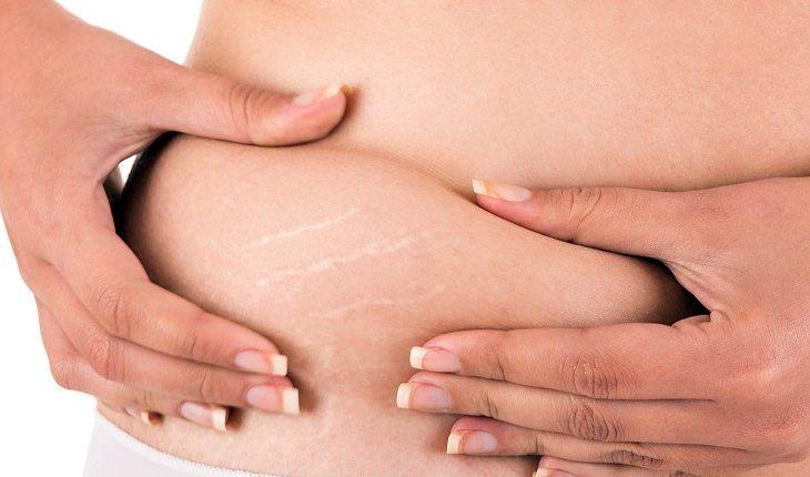 Estrias: causas, prevenção e alimentação correta para evitar as marcas na pele