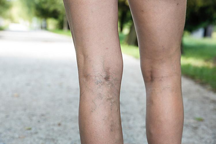 perna de uma mulher com varizes 