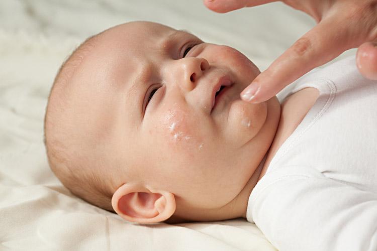 bebê com dermatite 