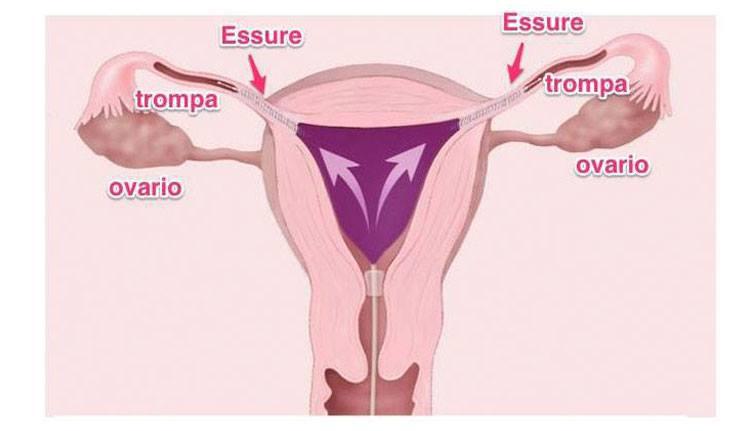 imagem ilustrativa de procedimento do anticoncepcional Essure