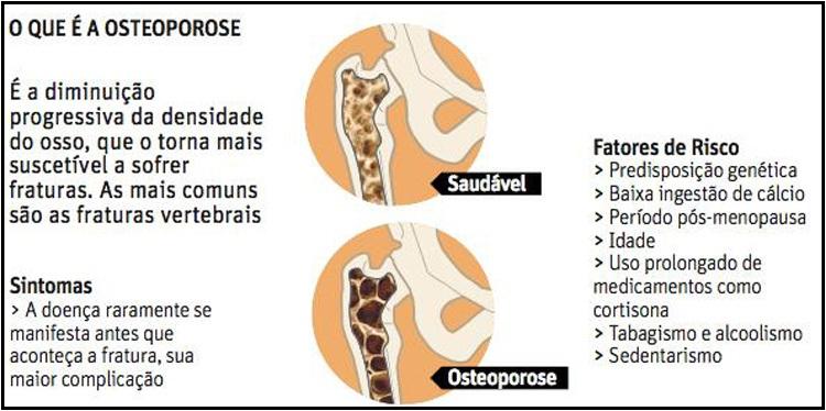 Pai de Xuxa sofre de osteoporose: como a doença age na estrutura óssea
