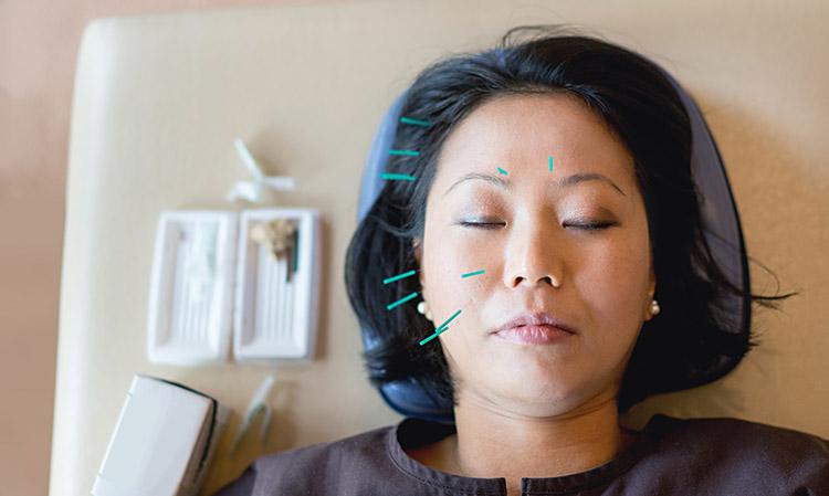 acupuntura 