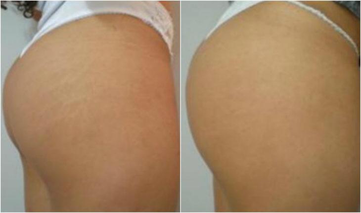 Antes e depois da micropigmentação para estrias