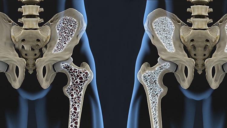 tira-duvidas-sobre-osteoporose (2)