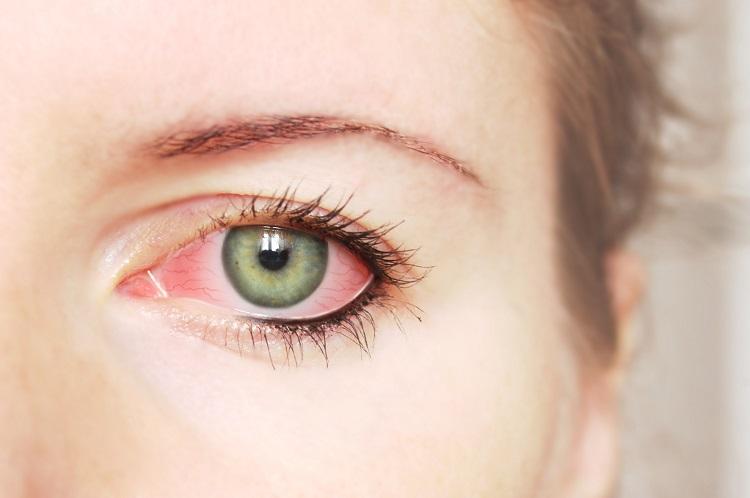 mulher com olho vermelho por causa de uma conjuntivite.